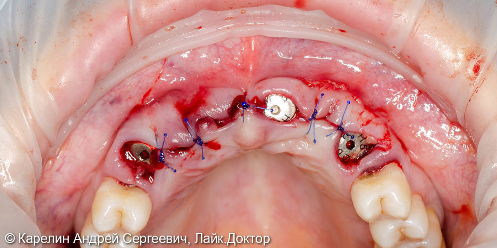 Эстетическая реабилитация на имплантатах пациентки с пародонтозом верхних резцов - фото №6