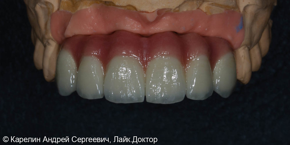Эстетическая реабилитация на имплантатах пациентки с пародонтозом верхних резцов - фото №13