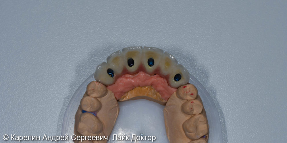 Эстетическая реабилитация на имплантатах пациентки с пародонтозом верхних резцов - фото №14