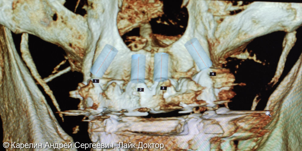 Тотальная реконструкция зубочелюстной системы с помощью имплантатов и 2 бюгелей с балочной фиксацией на имплантаты - фото №11