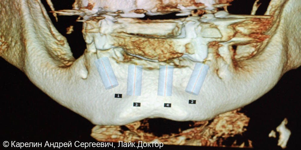 Тотальная реконструкция зубочелюстной системы с помощью имплантатов и 2 бюгелей с балочной фиксацией на имплантаты - фото №14