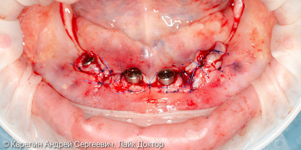 Тотальная реконструкция зубочелюстной системы с помощью имплантатов и 2 бюгелей с балочной фиксацией на имплантаты - фото №15