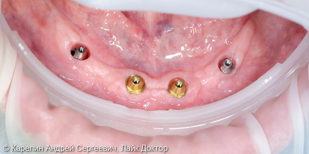 Тотальная реконструкция зубочелюстной системы с помощью имплантатов и 2 бюгелей с балочной фиксацией на имплантаты - фото №22