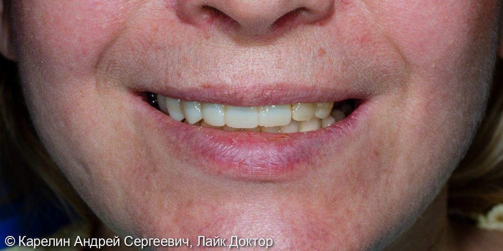 Протезирование на имплантатах и зубах металлокерамическими коронками - фото №1