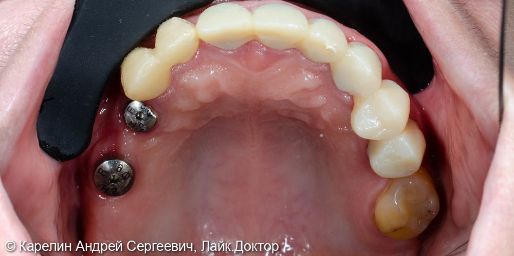 Протезирование на имплантатах и зубах металлокерамическими коронками - фото №5
