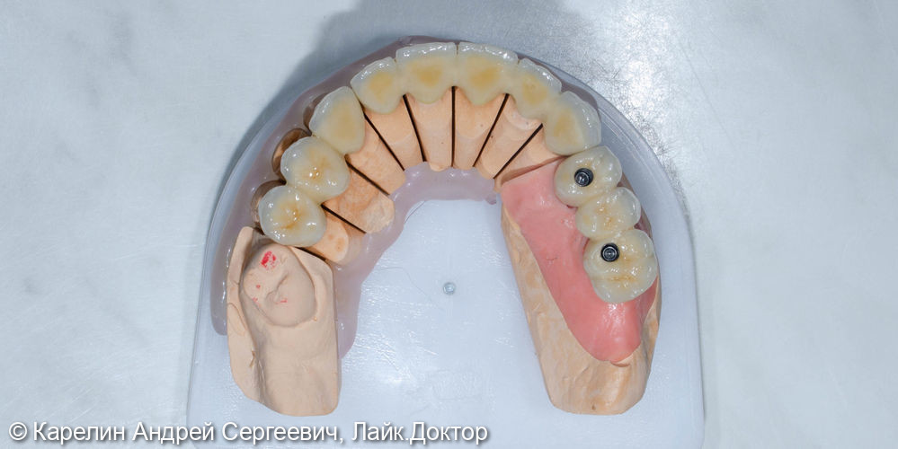 Протезирование на имплантатах и зубах металлокерамическими коронками - фото №9