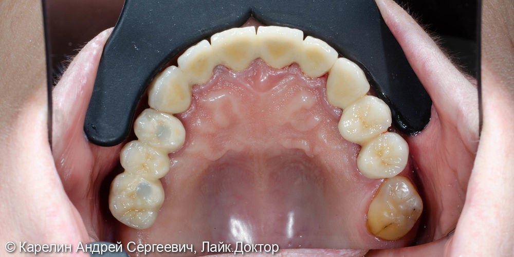 Протезирование на имплантатах и зубах металлокерамическими коронками - фото №15