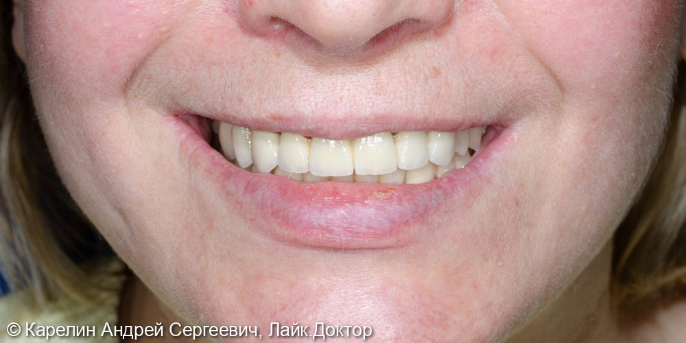 Протезирование на имплантатах и зубах металлокерамическими коронками - фото №18