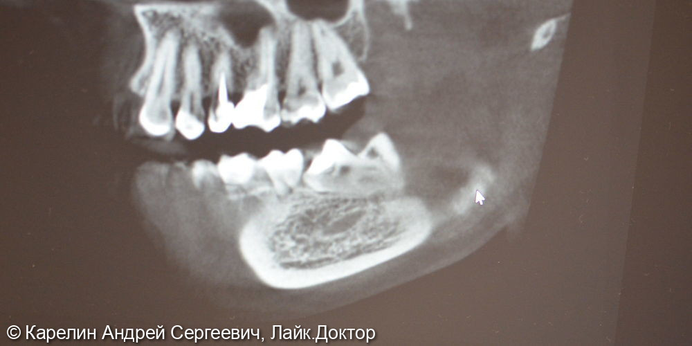 Удаление полуретинированного 3.8 зуба с крючковатым корнем - фото №2