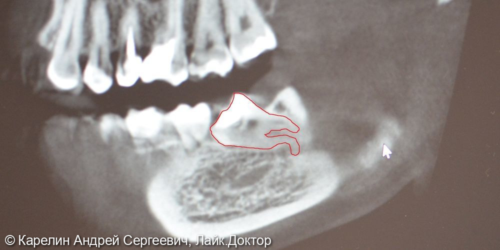 Удаление полуретинированного 3.8 зуба с крючковатым корнем - фото №3