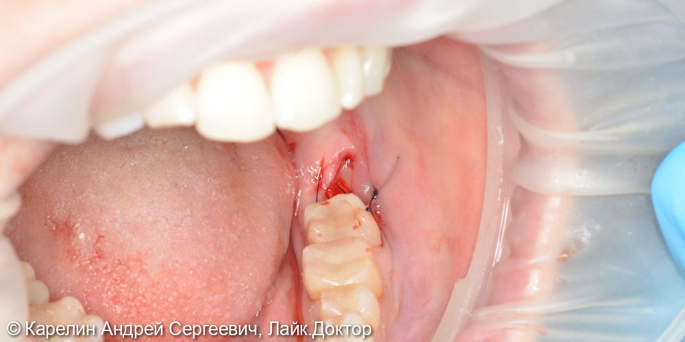 Удаление полуретинированного 3.8 зуба с крючковатым корнем - фото №6