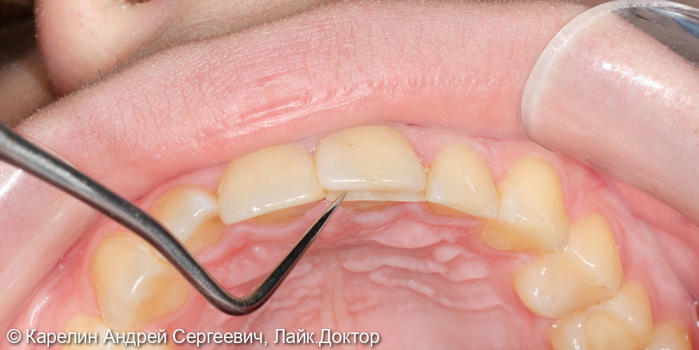 Лечене скола коронковой части зуба 2.1 - фото №3