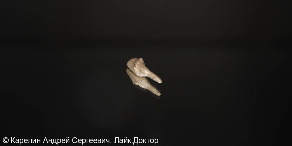 Лечене скола коронковой части зуба 2.1 - фото №5