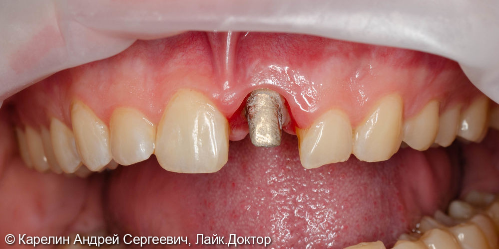 Лечене скола коронковой части зуба 2.1 - фото №6