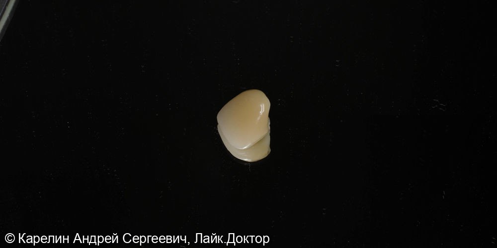 Лечене скола коронковой части зуба 2.1 - фото №7