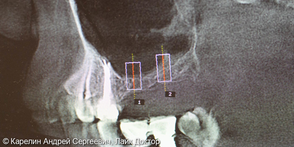 Открытый синуслифтинг с одномоментной имплантацией в области зубов 2.6 и 2.7 - фото №2