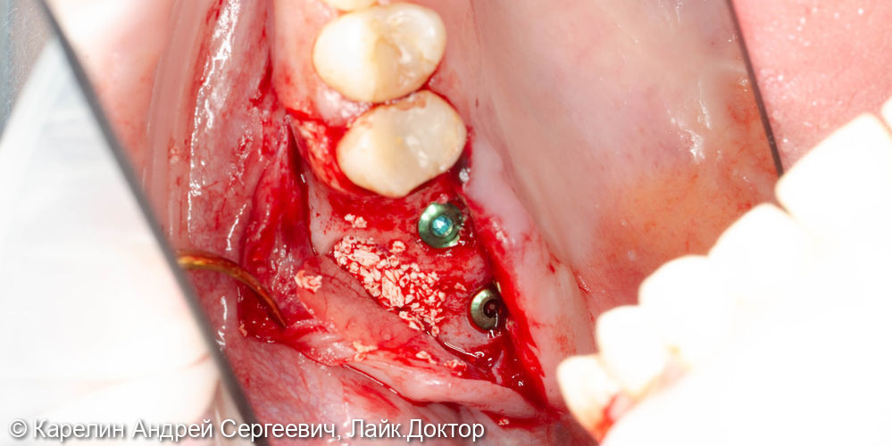 Открытый синуслифтинг с одномоментной имплантацией в области зубов 2.6 и 2.7 - фото №3