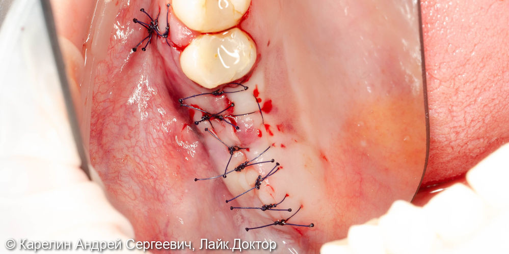 Открытый синуслифтинг с одномоментной имплантацией в области зубов 2.6 и 2.7 - фото №6