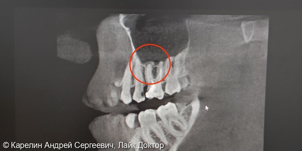 Лечение периодонтита зуба 2.6 - фото №1
