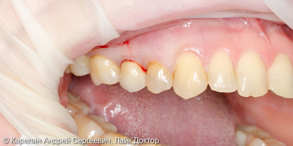 Атравматическое удаление, отсроченная имплантация и протезирование зубов 1.4 и 1.5 - фото №1