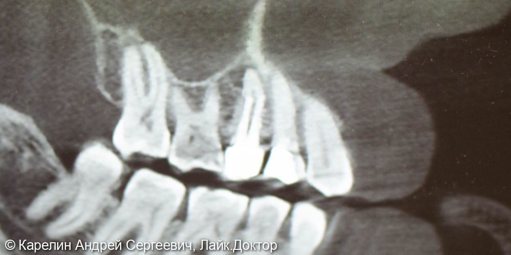 Атравматическое удаление, отсроченная имплантация и протезирование зубов 1.4 и 1.5 - фото №2