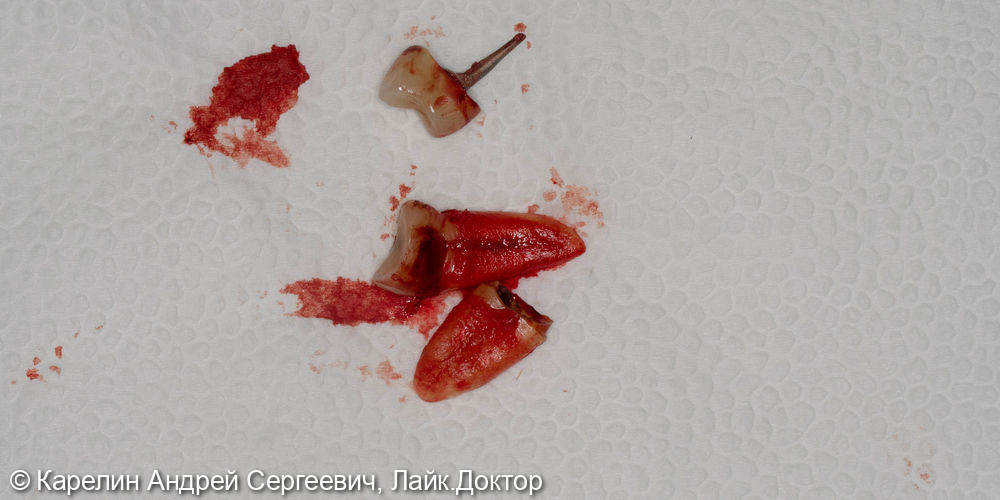 Атравматическое удаление, отсроченная имплантация и протезирование зубов 1.4 и 1.5 - фото №3