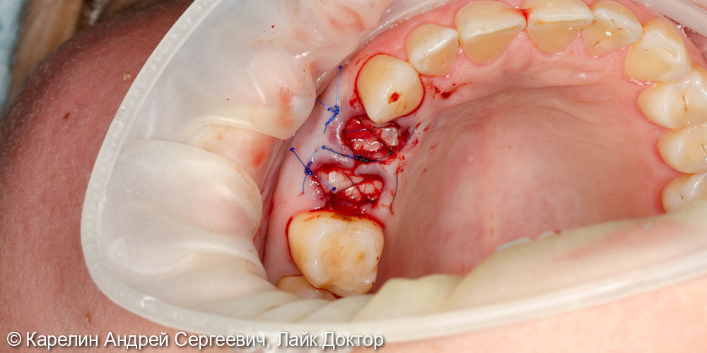 Атравматическое удаление, отсроченная имплантация и протезирование зубов 1.4 и 1.5 - фото №4