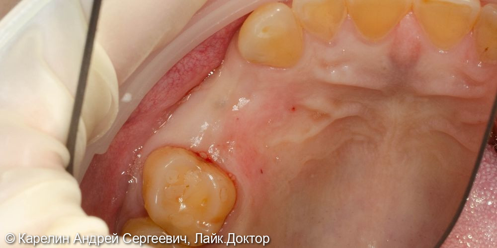 Атравматическое удаление, отсроченная имплантация и протезирование зубов 1.4 и 1.5 - фото №5