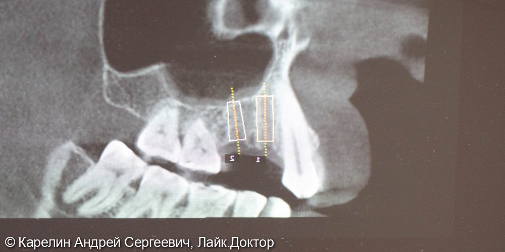 Атравматическое удаление, отсроченная имплантация и протезирование зубов 1.4 и 1.5 - фото №6