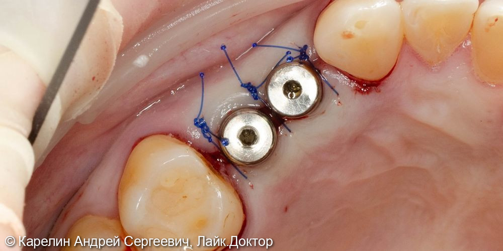 Атравматическое удаление, отсроченная имплантация и протезирование зубов 1.4 и 1.5 - фото №7