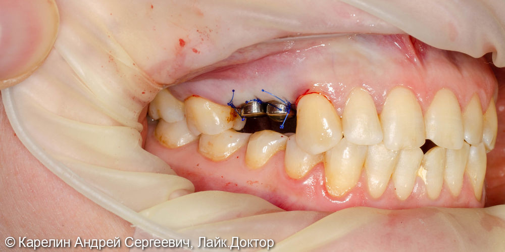 Атравматическое удаление, отсроченная имплантация и протезирование зубов 1.4 и 1.5 - фото №8