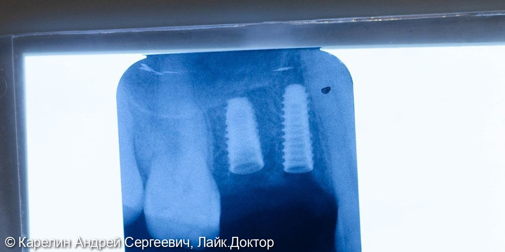 Атравматическое удаление, отсроченная имплантация и протезирование зубов 1.4 и 1.5 - фото №9