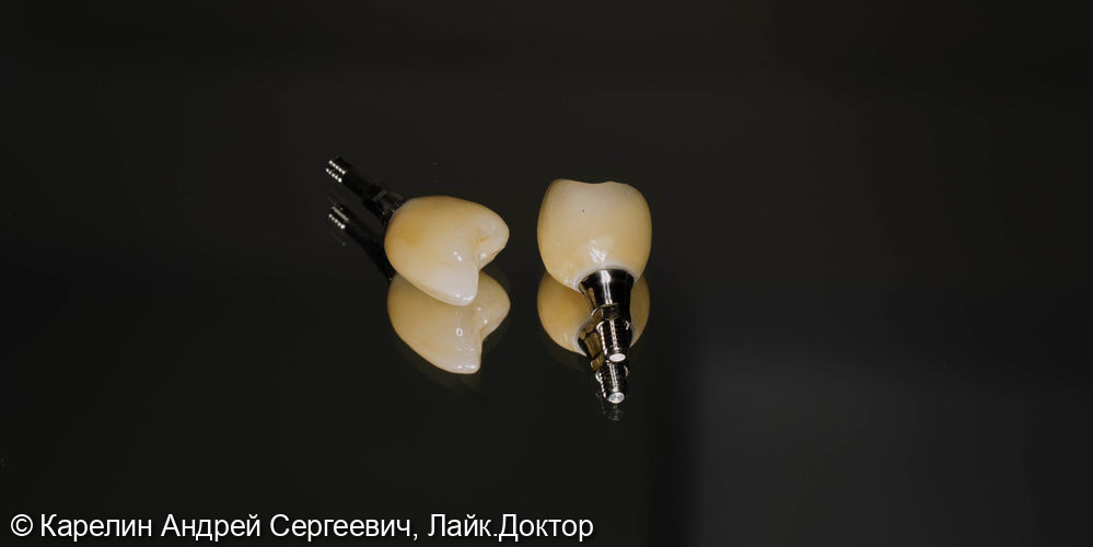 Атравматическое удаление, отсроченная имплантация и протезирование зубов 1.4 и 1.5 - фото №10