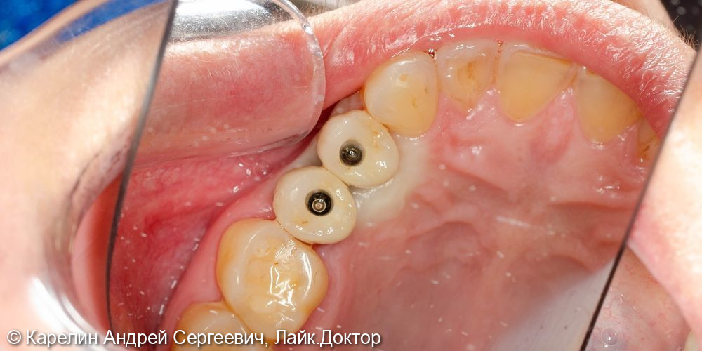 Атравматическое удаление, отсроченная имплантация и протезирование зубов 1.4 и 1.5 - фото №11