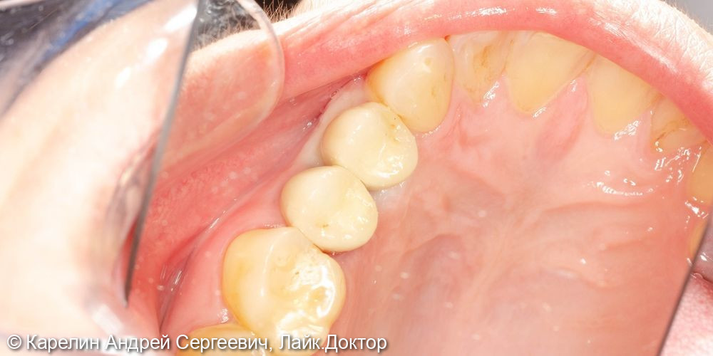 Атравматическое удаление, отсроченная имплантация и протезирование зубов 1.4 и 1.5 - фото №12