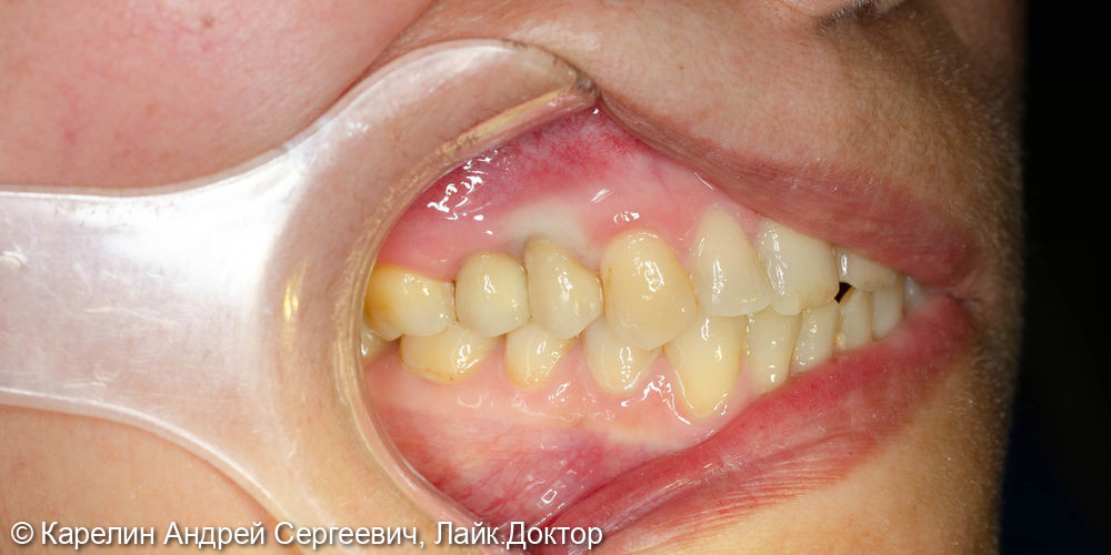 Атравматическое удаление, отсроченная имплантация и протезирование зубов 1.4 и 1.5 - фото №13