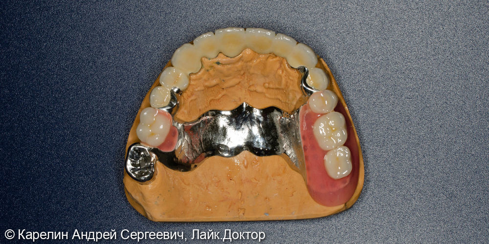 Тотальное протезирование обеих челюстей металлокерамическими коронками и бюгельными протезами - фото №5