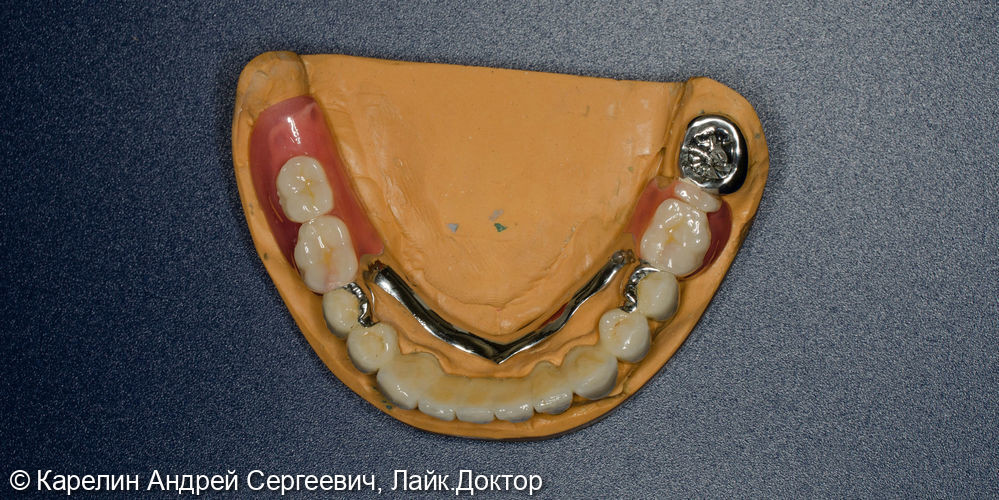 Тотальное протезирование обеих челюстей металлокерамическими коронками и бюгельными протезами - фото №6