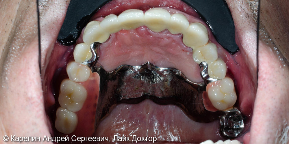 Тотальное протезирование обеих челюстей металлокерамическими коронками и бюгельными протезами - фото №7