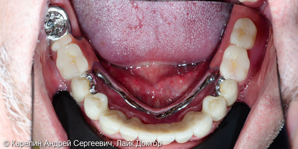 Тотальное протезирование обеих челюстей металлокерамическими коронками и бюгельными протезами - фото №8