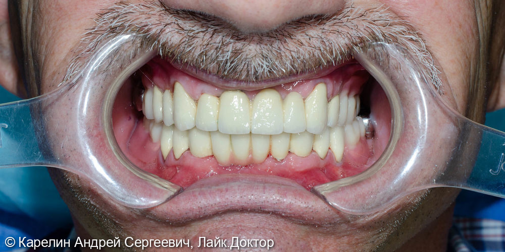 Тотальное протезирование обеих челюстей металлокерамическими коронками и бюгельными протезами - фото №10