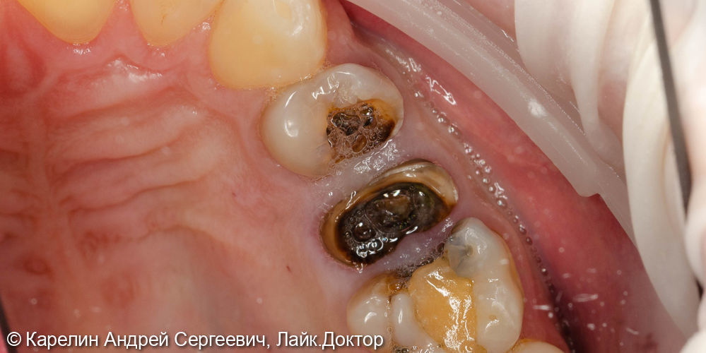 Удаление и отсроченная имплантация 2 зубов - фото №1