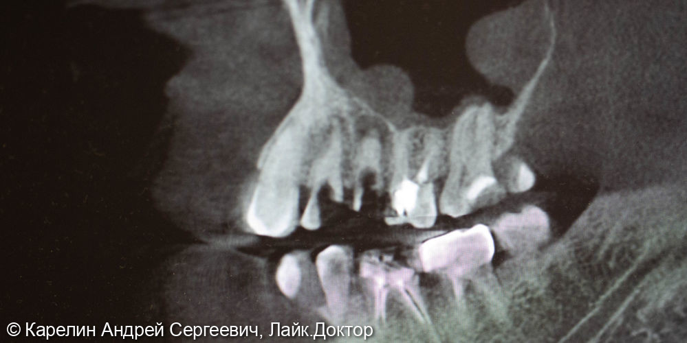 Удаление и отсроченная имплантация 2 зубов - фото №2