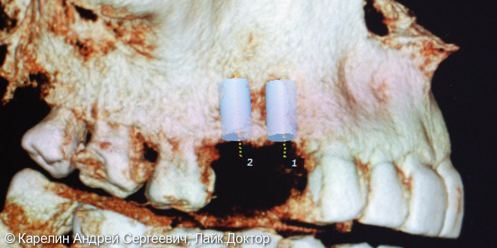 Удаление и отсроченная имплантация 2 зубов - фото №6