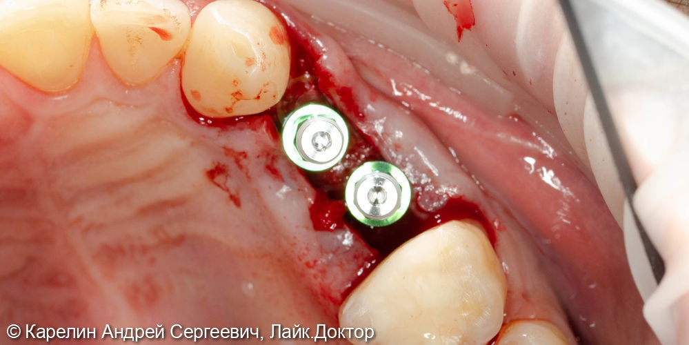 Удаление и отсроченная имплантация 2 зубов - фото №7