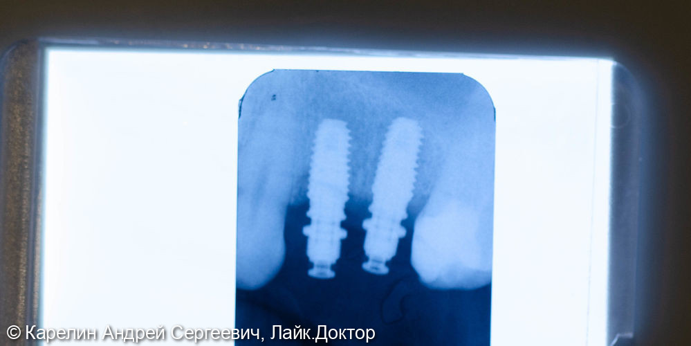 Удаление и отсроченная имплантация 2 зубов - фото №8