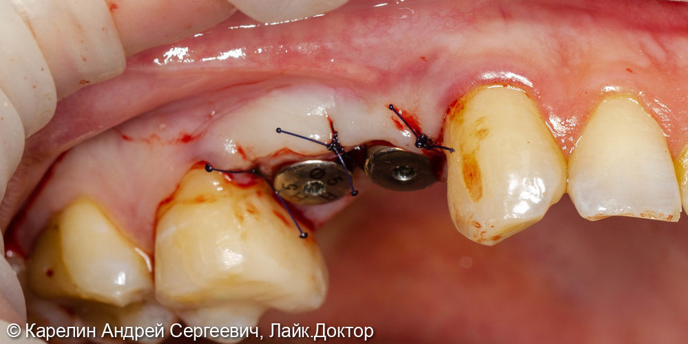 Удаление и отсроченная имплантация 2 зубов - фото №9