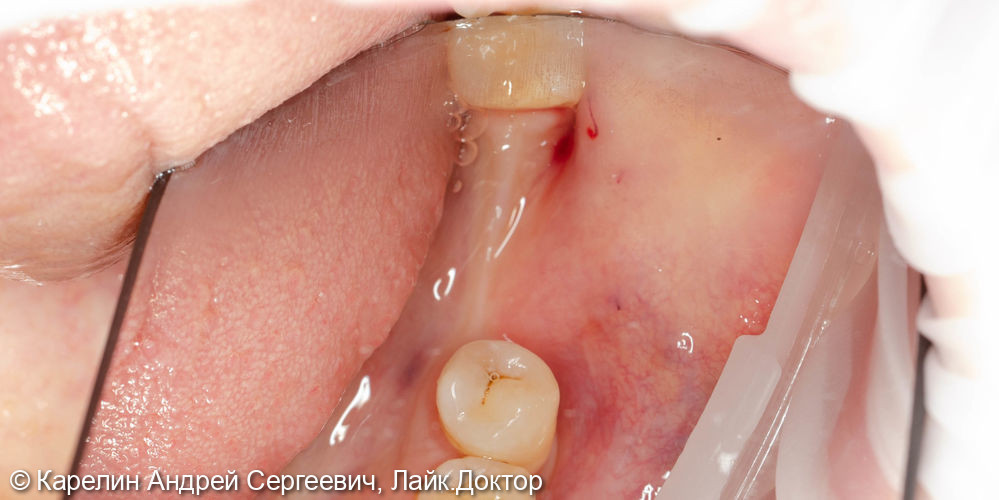 Отсроченая пластика слизистой, имплантация и удаление зуба мудрости - фото №1