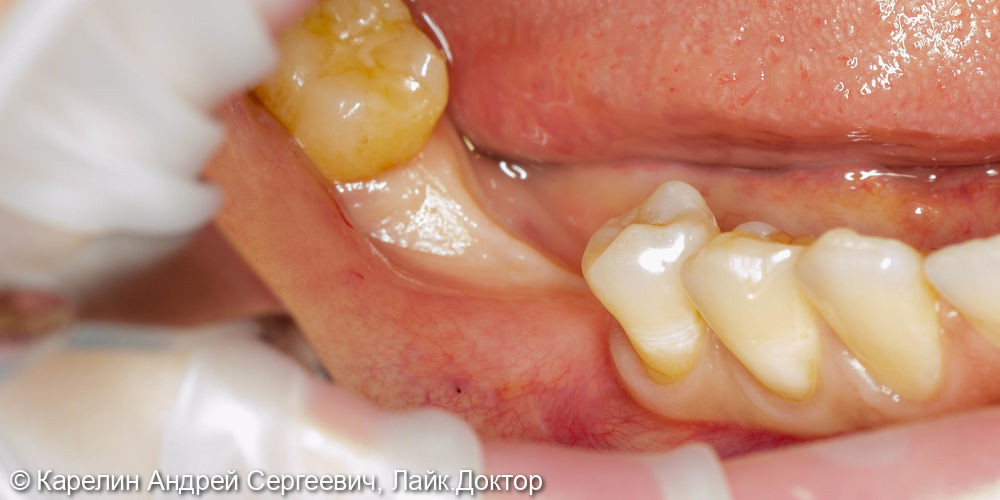 Отсроченая пластика слизистой, имплантация и удаление зуба мудрости - фото №2