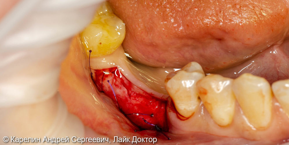 Отсроченая пластика слизистой, имплантация и удаление зуба мудрости - фото №3